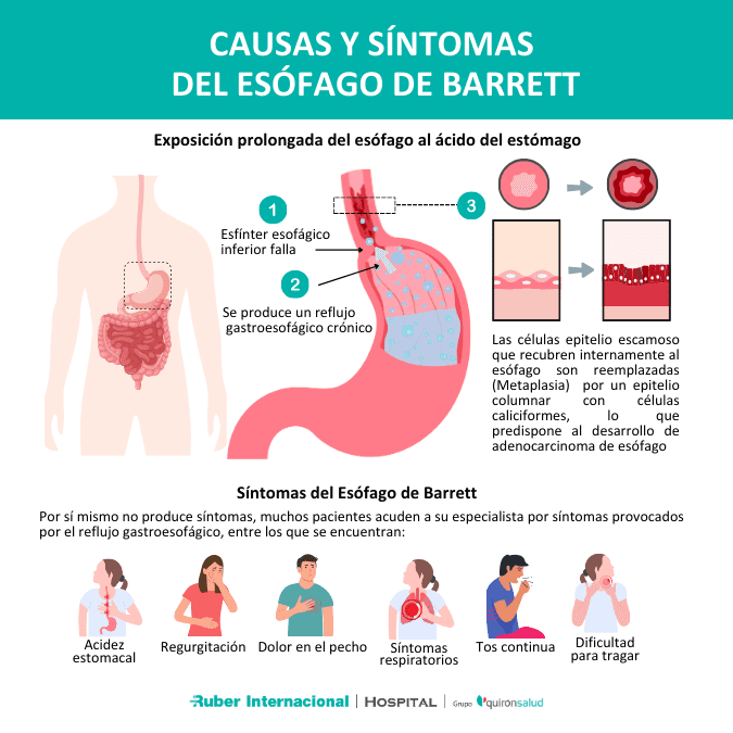 Esófago de Barrett: Causas, síntomas, diagnóstico y tratamiento
